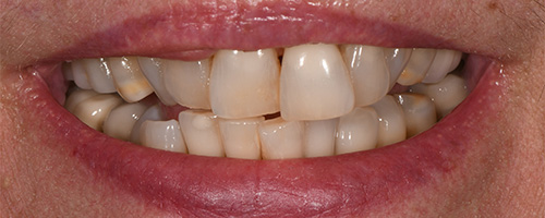 Before After images, Before Image-48 - Walden Dental