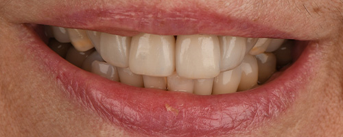 Before After images, After Image-48 - Walden Dental