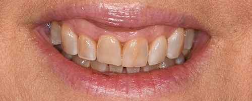 Before After images, Before Image-49 - Walden Dental