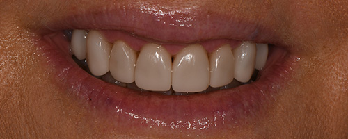 Before After images, After Image-49 - Walden Dental