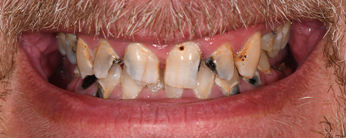Before After images, Before Image-50 - Walden Dental