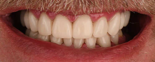 Before After images, After Image-50 - Walden Dental