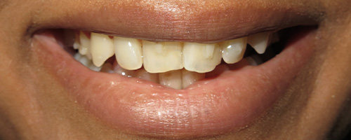 Before After images, Before Image-51 - Walden Dental