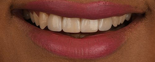 Before After images, After Image-51 - Walden Dental