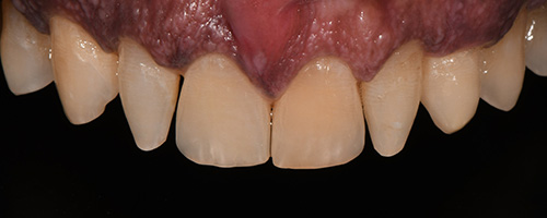 Before After images, Before Image-52 - Walden Dental