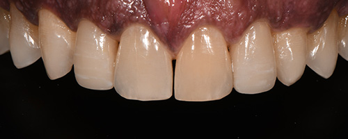 Before After images, After Image-52 - Walden Dental