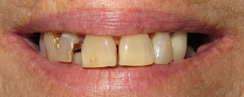 Before After images, Before Image-53 - Walden Dental