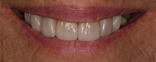 Before After images, After Image-53 - Walden Dental