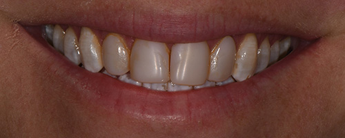 Before After images, Before Image-54 - Walden Dental