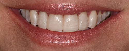 Before After images, After Image-54 - Walden Dental