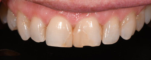 Before After images, Before Image-55 - Walden Dental