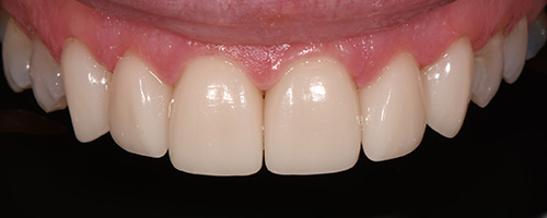 Before After images, After Image-55 - Walden Dental