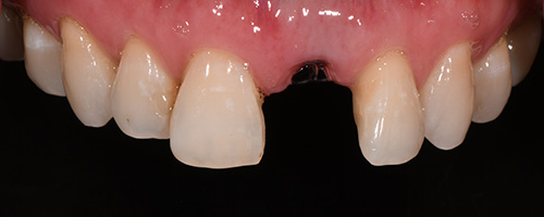 Before After images, Before Image-56 - Walden Dental