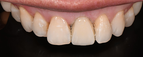 Before After images, After Image-56 - Walden Dental