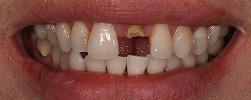Before After images, Before Image-54 - Walden Dental