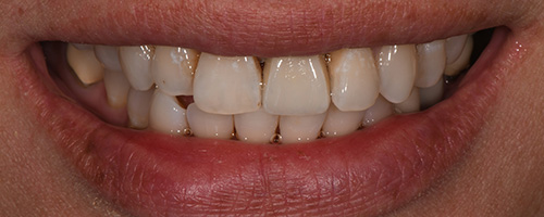Before After images, After Image-54 - Walden Dental