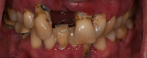 Before After images, Before Image-58 - Walden Dental