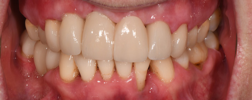Before After images, After Image-58 - Walden Dental