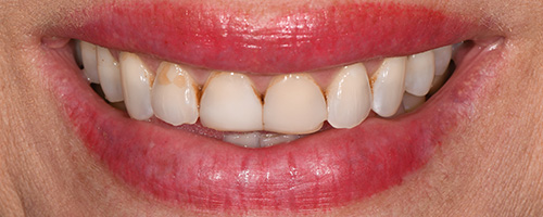Before After images, Before Image-59 - Walden Dental
