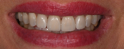 Before After images, After Image-59 - Walden Dental