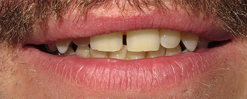 Before After images, Before Image-60 - Walden Dental