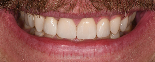 Before After images, Before Image-60 - Walden Dental
