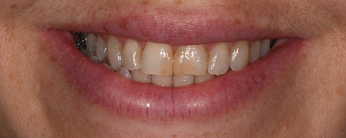 Smiling mouth with discolored and uneven front teeth