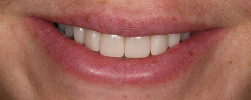 Close-up of a smiling mouth with white, even teeth