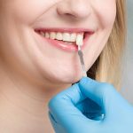 Teeth Porcelain Veneers in Austin TX Area