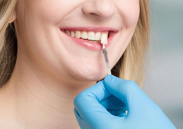 Teeth Porcelain Veneers in Austin TX Area