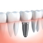 3D dental implant illustration highlighting expert maintenance tips for long‑lasting results in Austin TX